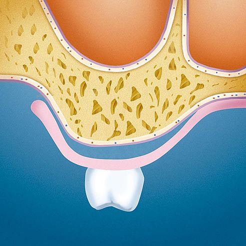 Zubná náhrada počas prechodného obdobia (medzery medzi alveolárnym hrebeňom a dočasnou zubnou náhradou) | Protefix